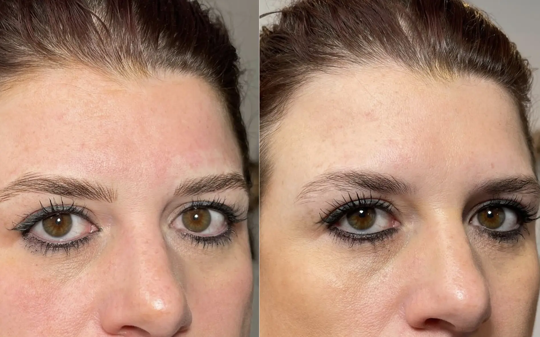 Patchy brow healing