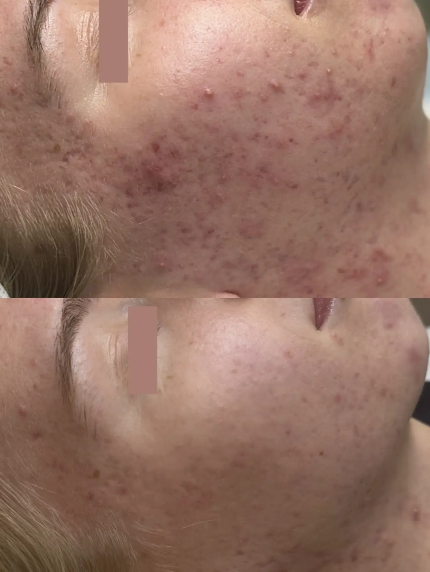 What In-Clinic Treatments Are Worth It For Scarring Or Pigmentation?