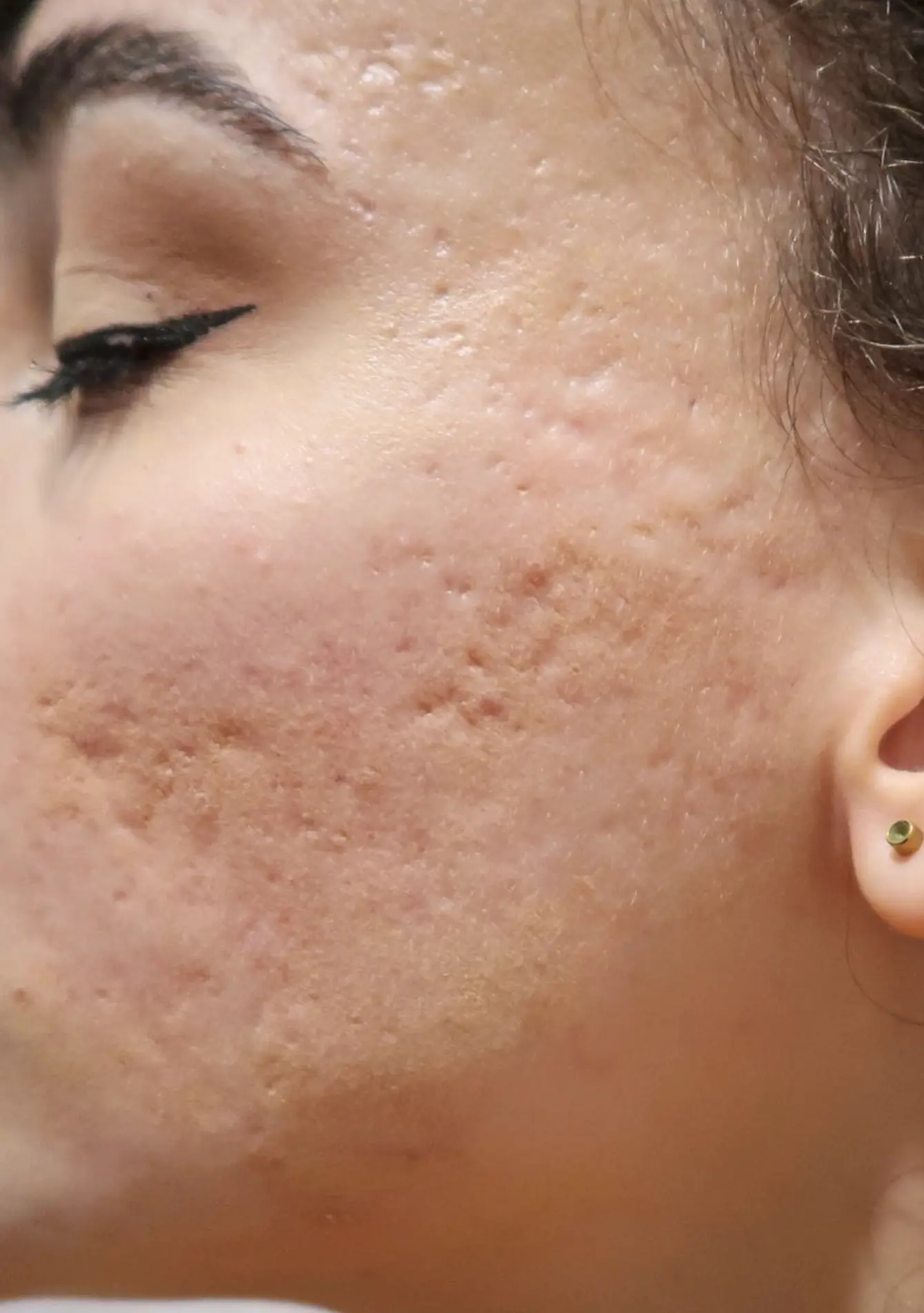 chemical peels for hyperpigmentation treatment
