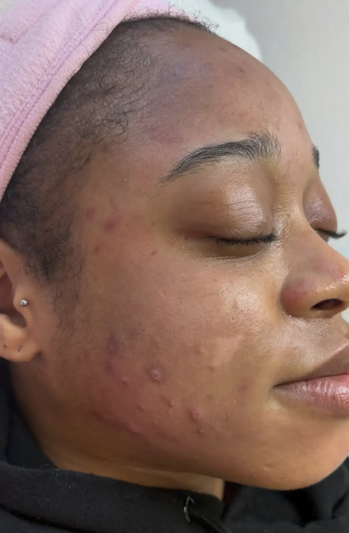 fractional laser treatment for acne scars