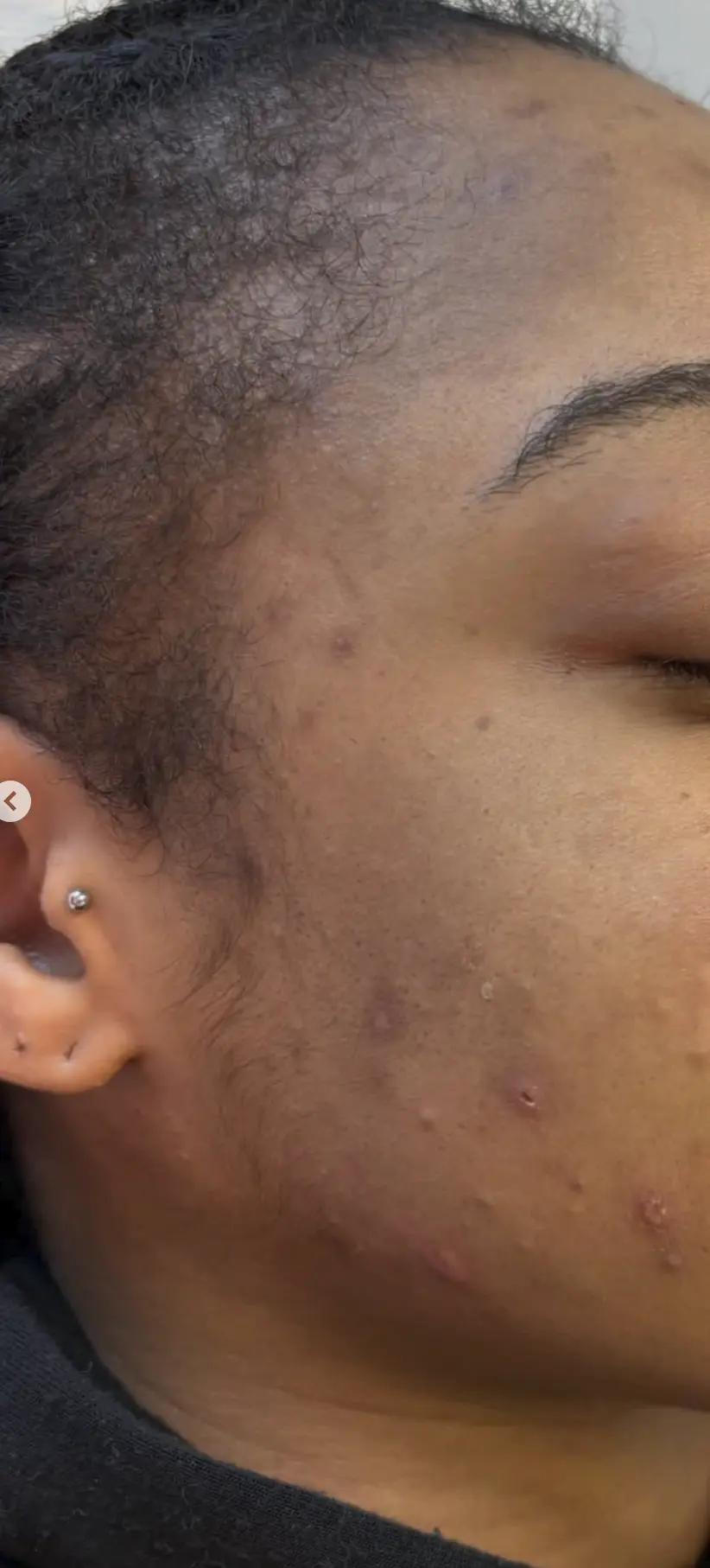 microneedling for acne scars and collagen