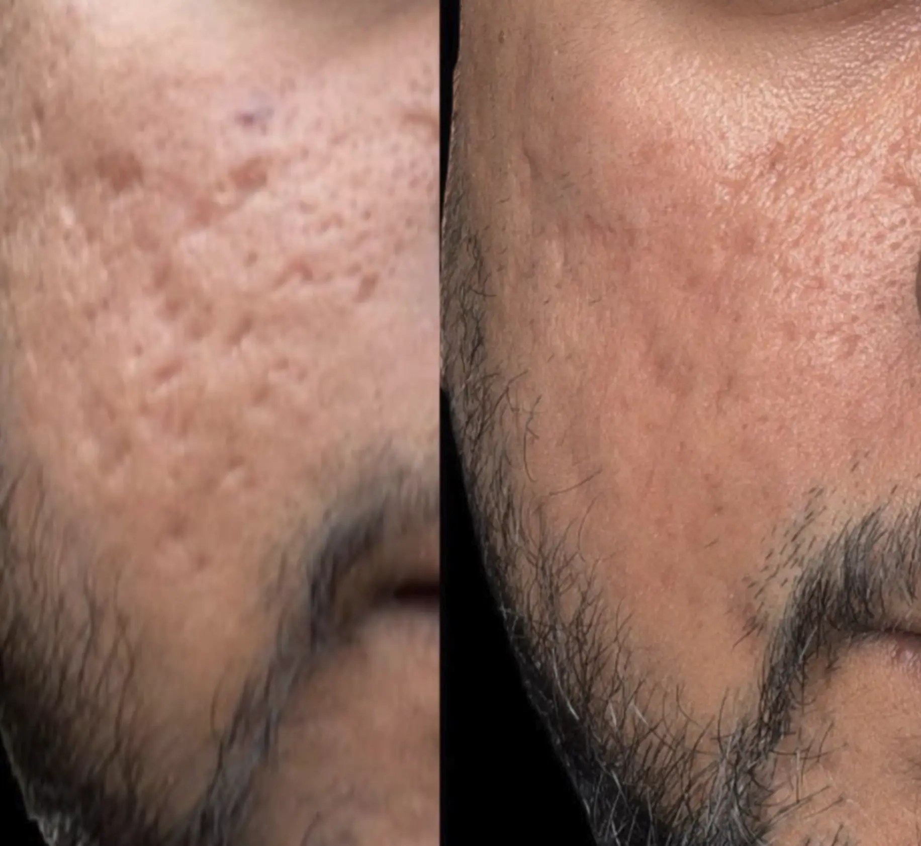 radiofrequency microneedling for acne scars