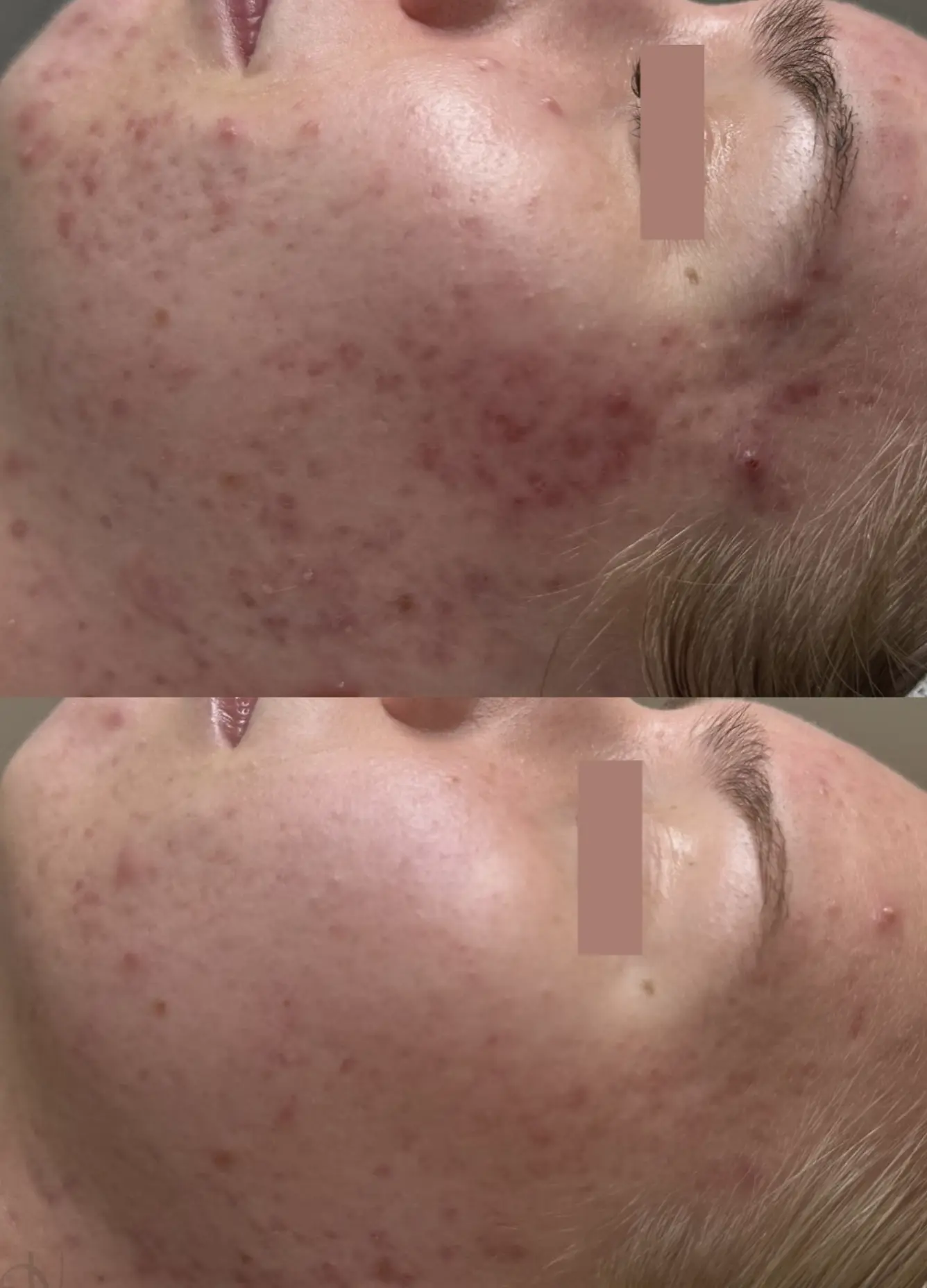 what in clinic treatments work for acne scars